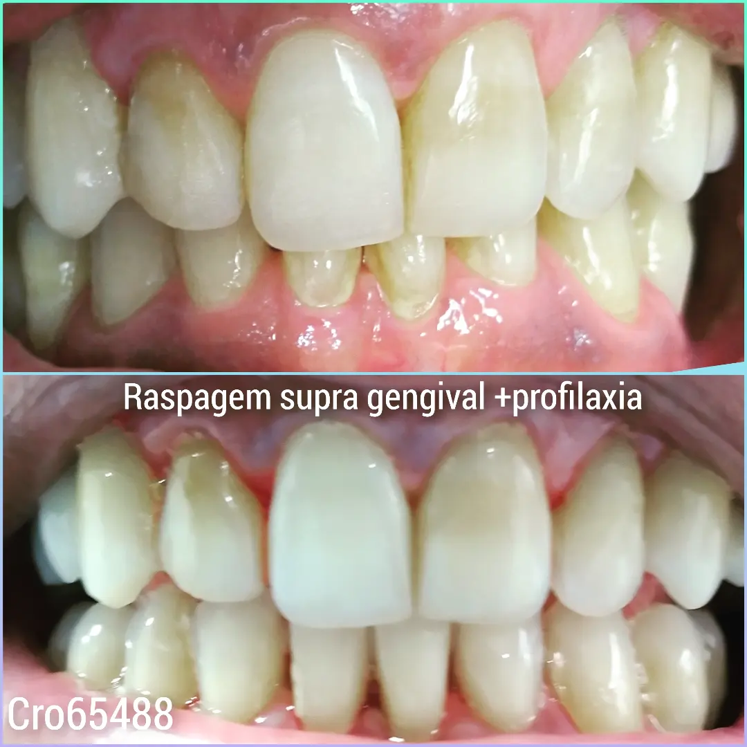 Restauração Natural (antes e depois)